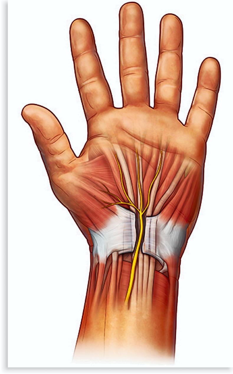 Carpal tunnel syndrome - what can be done to help? Carpal tunnel syndrome - what can be done to help?