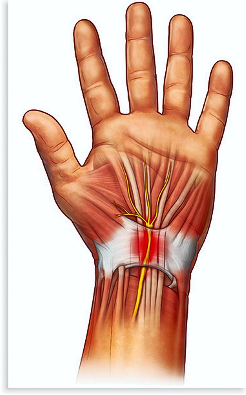 Carpal tunnel syndrome - what can be done to help? Carpal tunnel syndrome - what can be done to help?